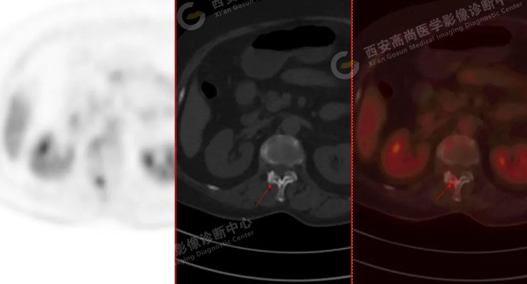 高尚病例：PET/CT 诊断多发性骨髓瘤 1 例
