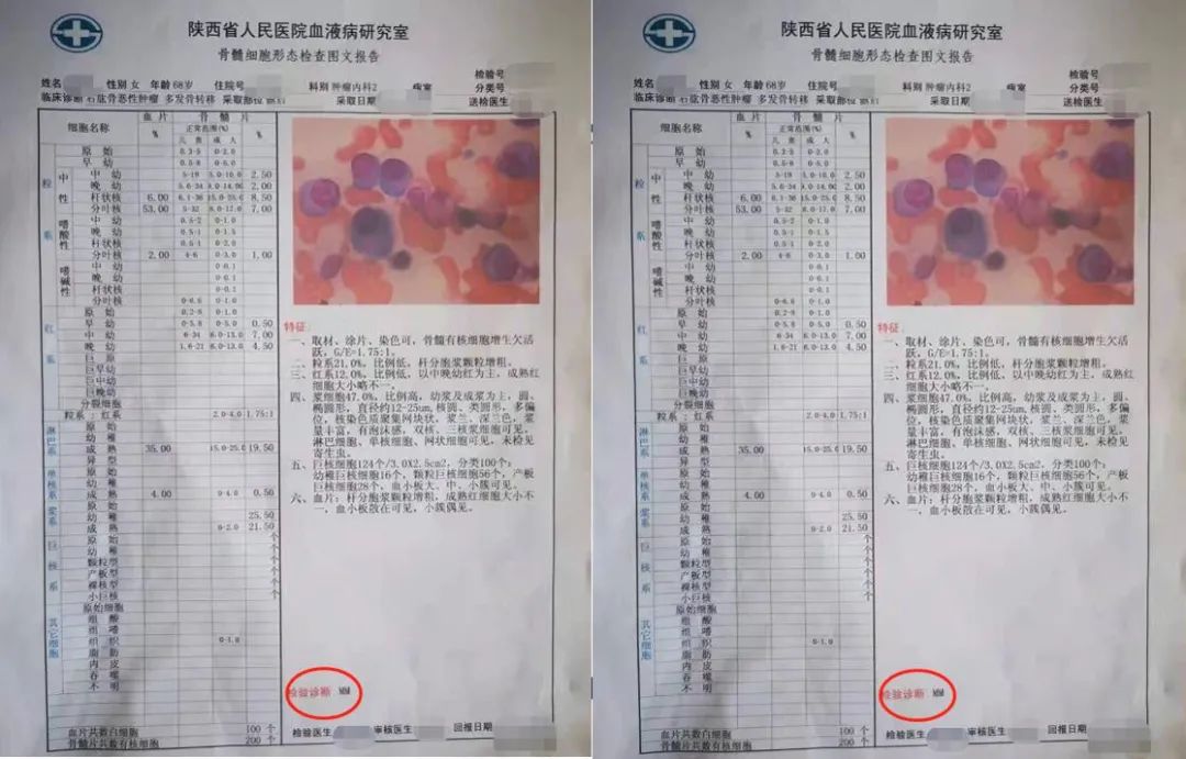 高尚病例：PET/CT 诊断多发性骨髓瘤 1 例