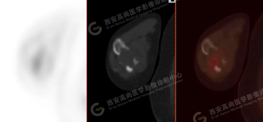 高尚病例：PET/CT 诊断多发性骨髓瘤 1 例
