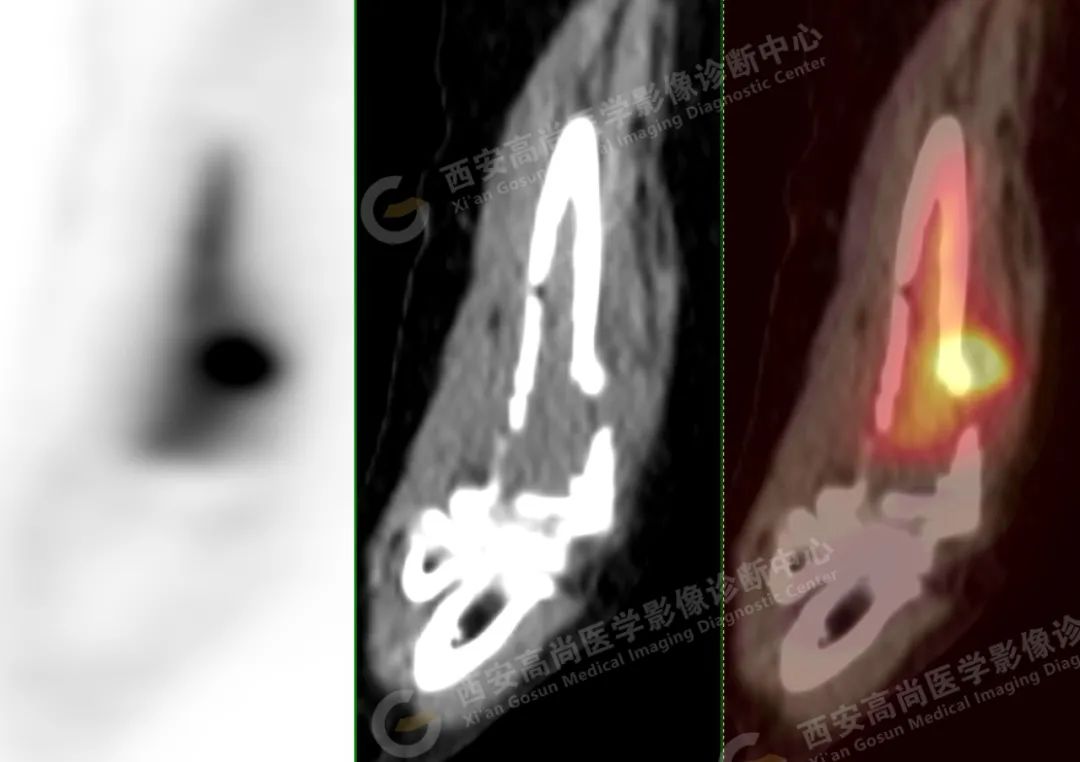 高尚病例：PET/CT 诊断多发性骨髓瘤 1 例