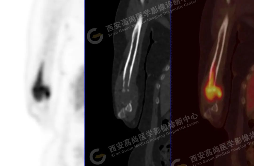 高尚病例：PET/CT 诊断多发性骨髓瘤 1 例