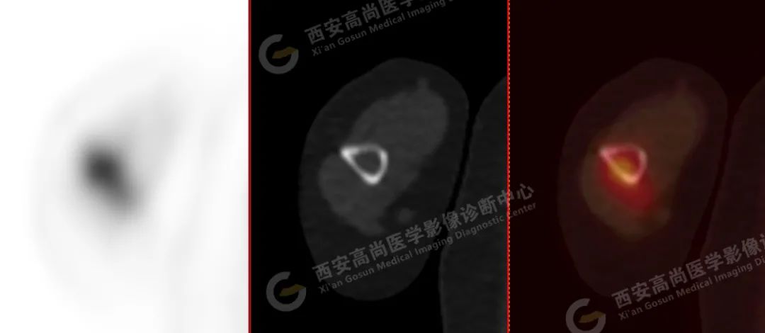 高尚病例：PET/CT 诊断多发性骨髓瘤 1 例