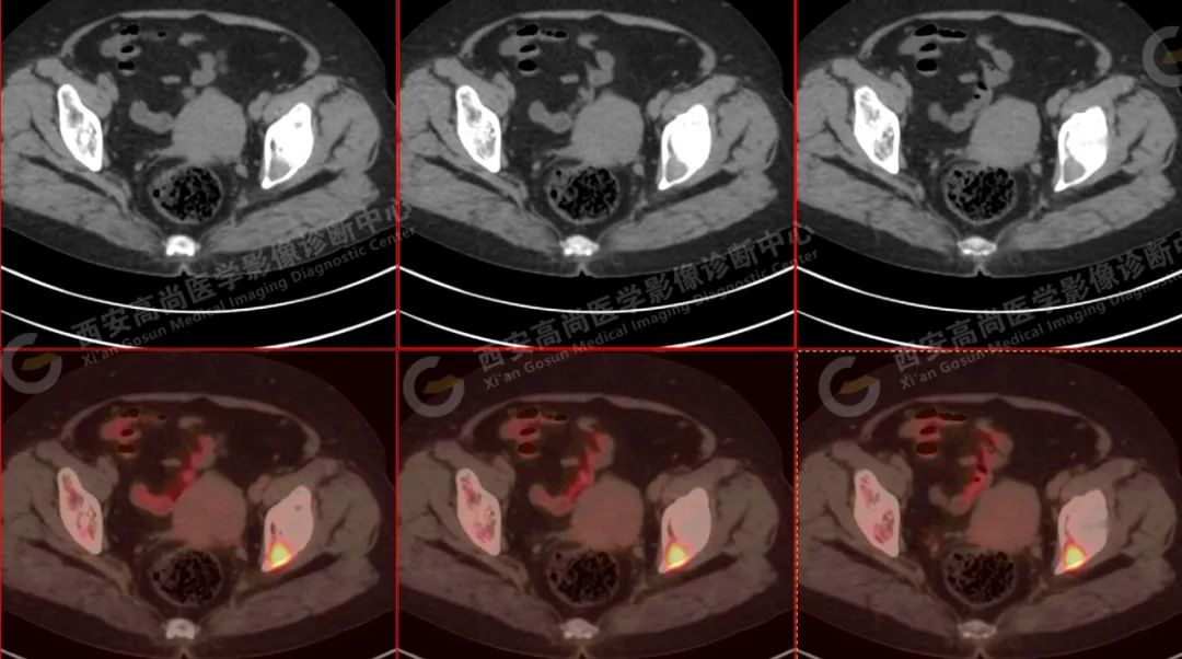 高尚病例：PET/CT 诊断多发性骨髓瘤 1 例