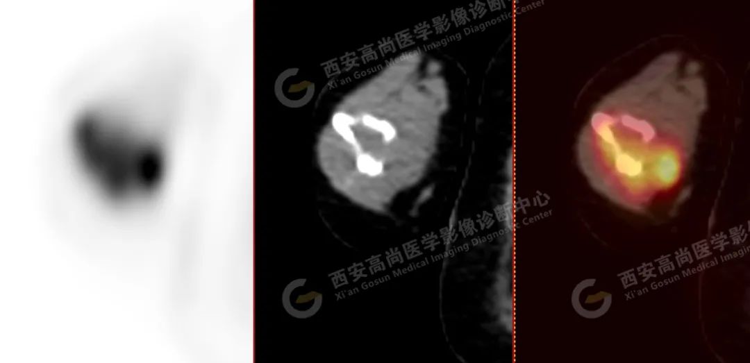 高尚病例：PET/CT 诊断多发性骨髓瘤 1 例