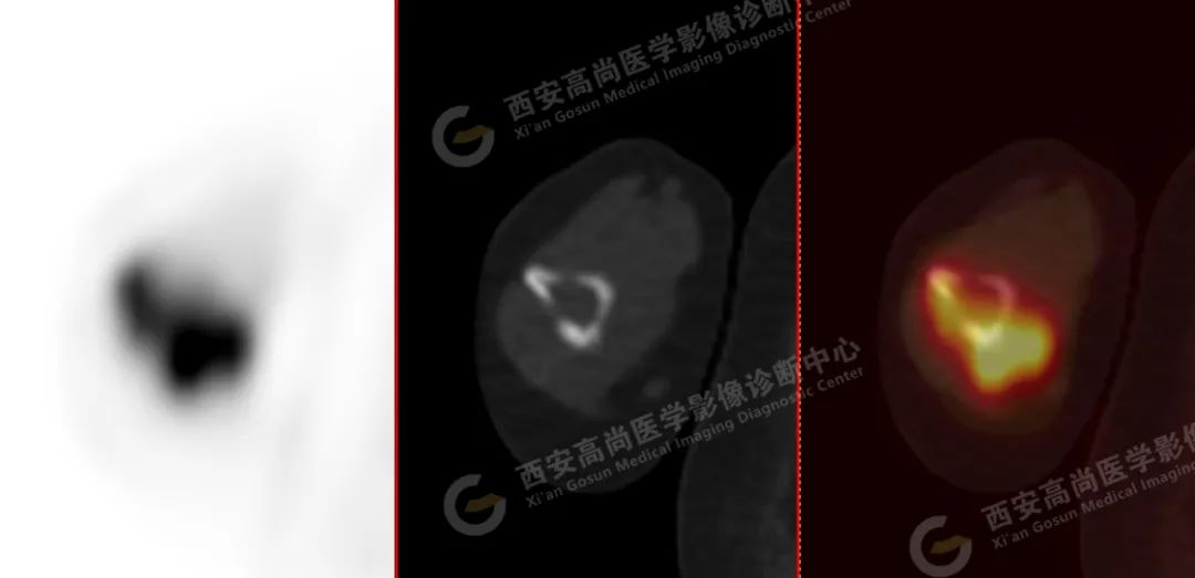 高尚病例：PET/CT 诊断多发性骨髓瘤 1 例