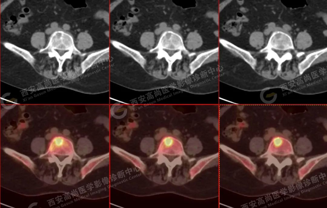 高尚病例：PET/CT 诊断多发性骨髓瘤 1 例