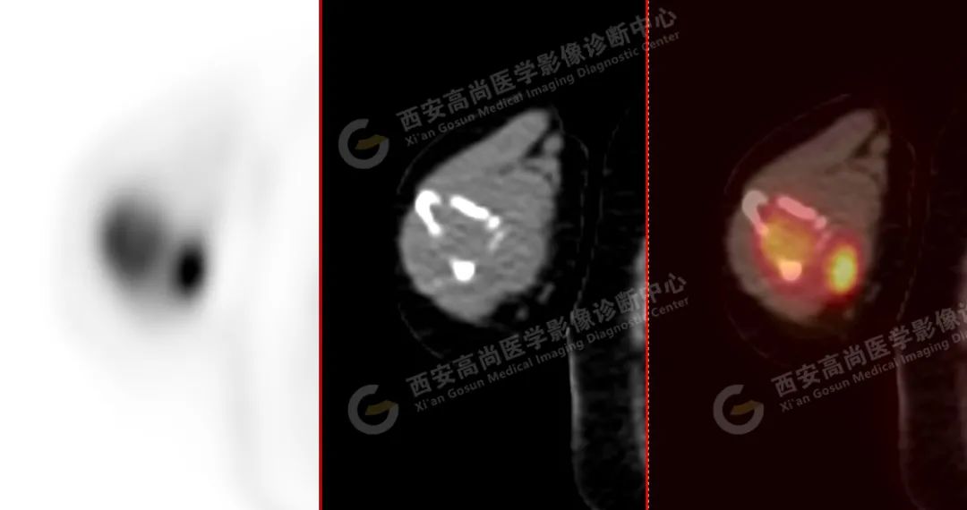 高尚病例：PET/CT 诊断多发性骨髓瘤 1 例
