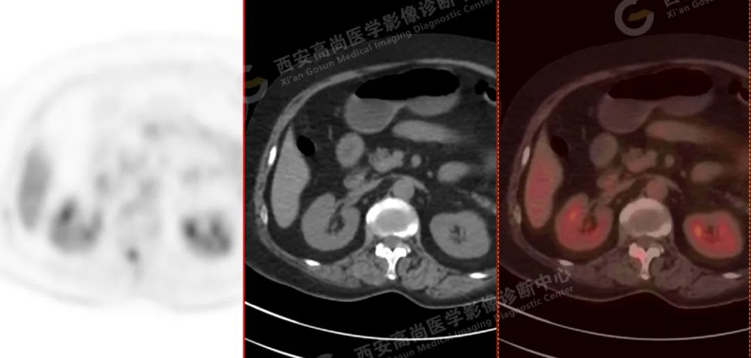 高尚病例：PET/CT 诊断多发性骨髓瘤 1 例