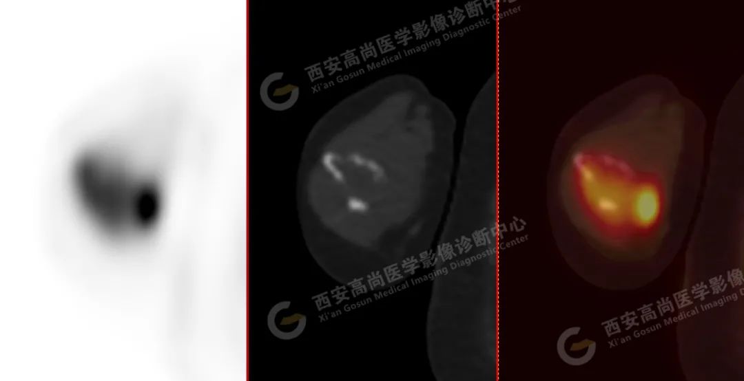 高尚病例：PET/CT 诊断多发性骨髓瘤 1 例