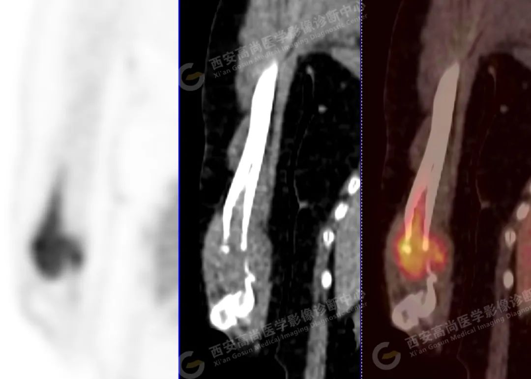 高尚病例：PET/CT 诊断多发性骨髓瘤 1 例