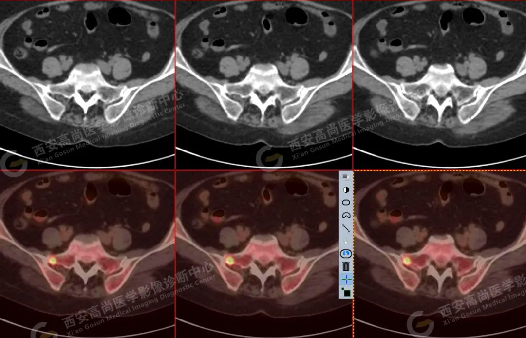 高尚病例：PET/CT 诊断多发性骨髓瘤 1 例