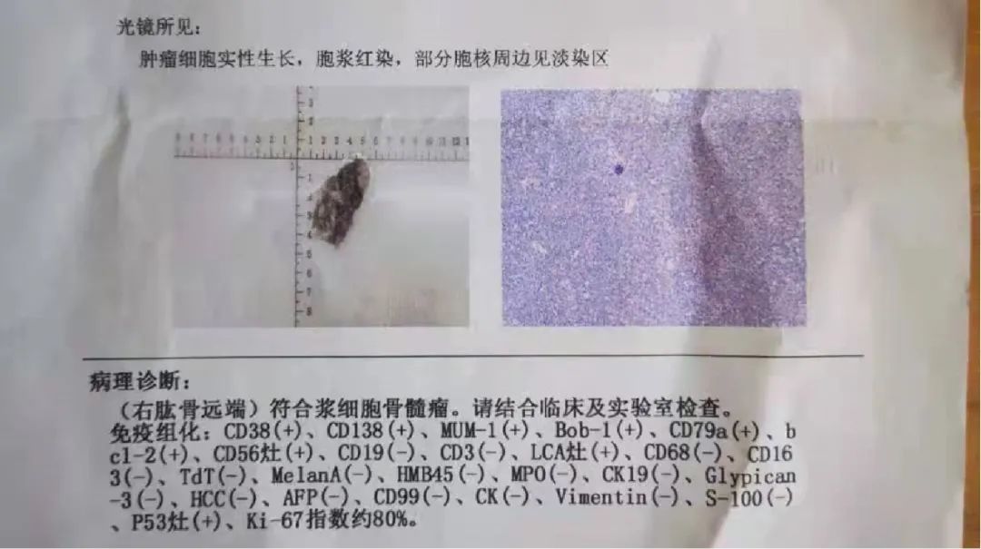 高尚病例：PET/CT 诊断多发性骨髓瘤 1 例