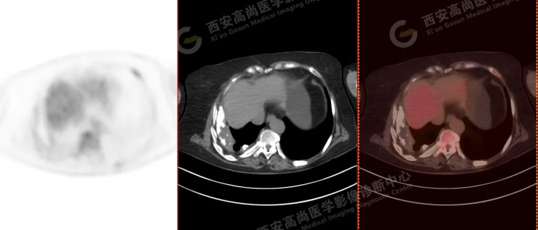高尚病例：PET/CT 诊断多发性骨髓瘤 1 例