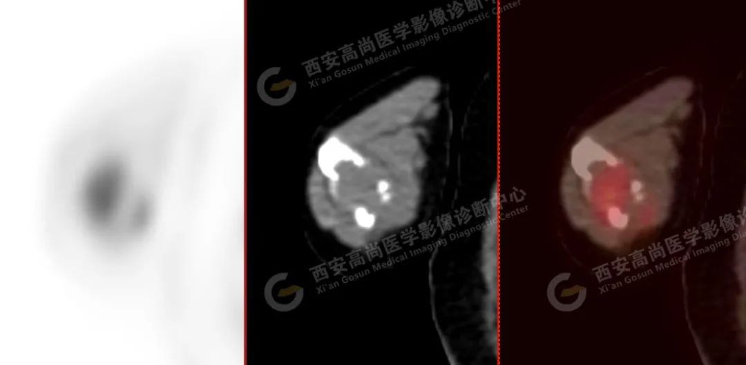高尚病例：PET/CT 诊断多发性骨髓瘤 1 例