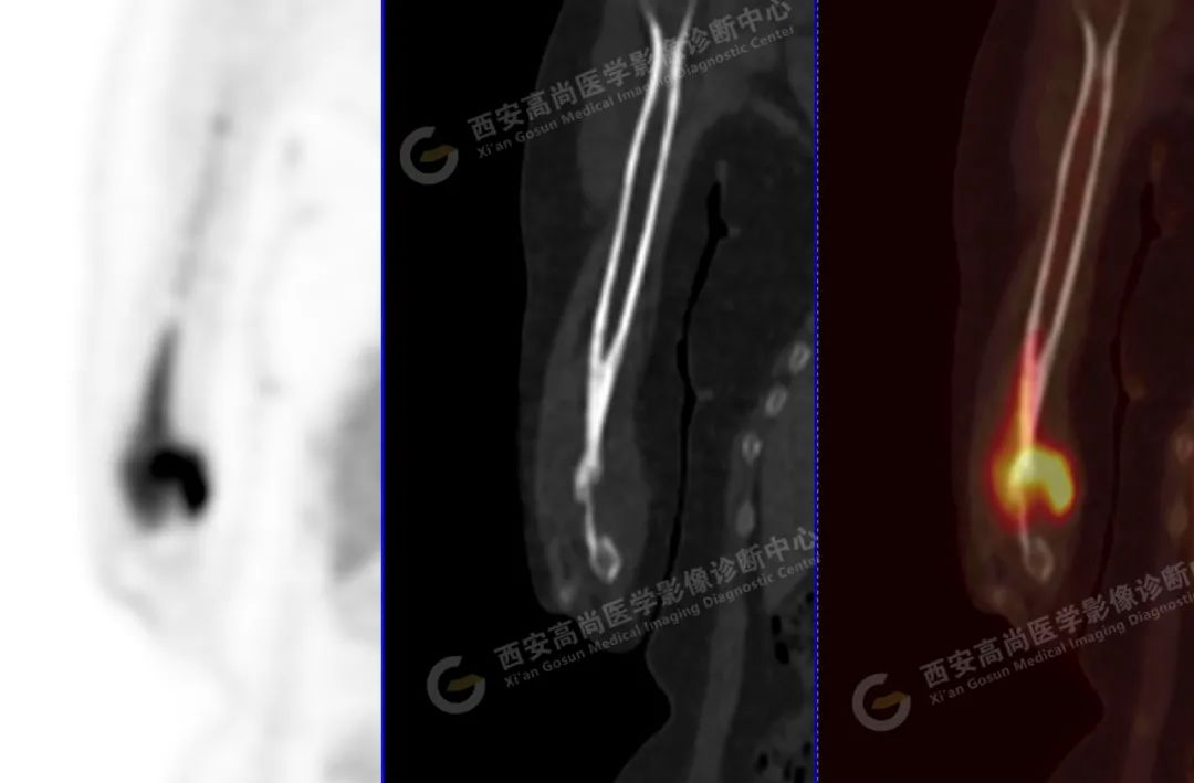高尚病例：PET/CT 诊断多发性骨髓瘤 1 例