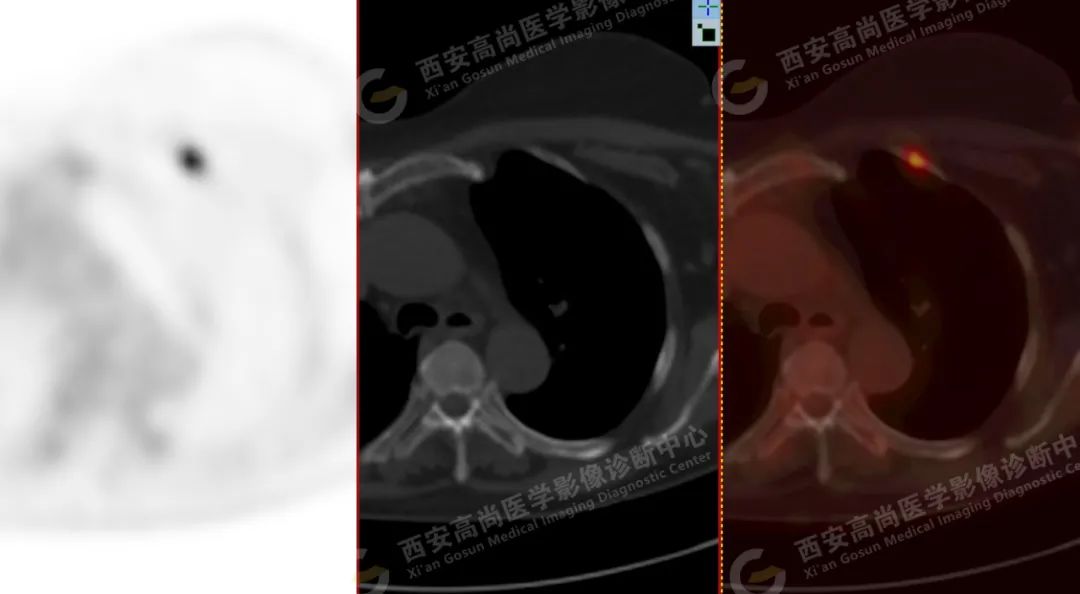 高尚病例：PET/CT 诊断多发性骨髓瘤 1 例
