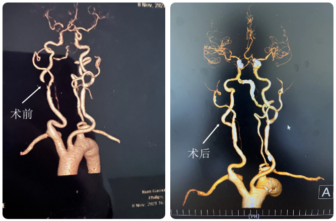 单侧颈动脉狭窄 90%,这队「超级血管工」做的疏通手术撩咋咧