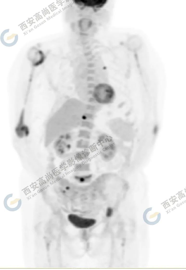 高尚病例：PET/CT 诊断多发性骨髓瘤 1 例