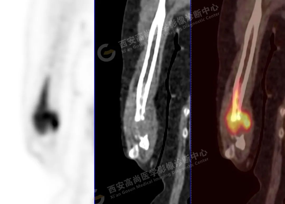 高尚病例：PET/CT 诊断多发性骨髓瘤 1 例