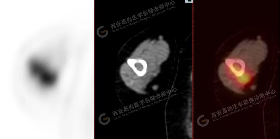 高尚病例：PET/CT 诊断多发性骨髓瘤 1 例