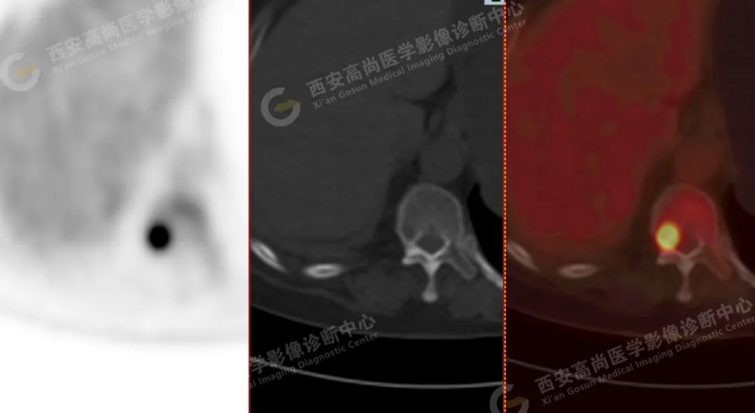 高尚病例：PET/CT 诊断多发性骨髓瘤 1 例