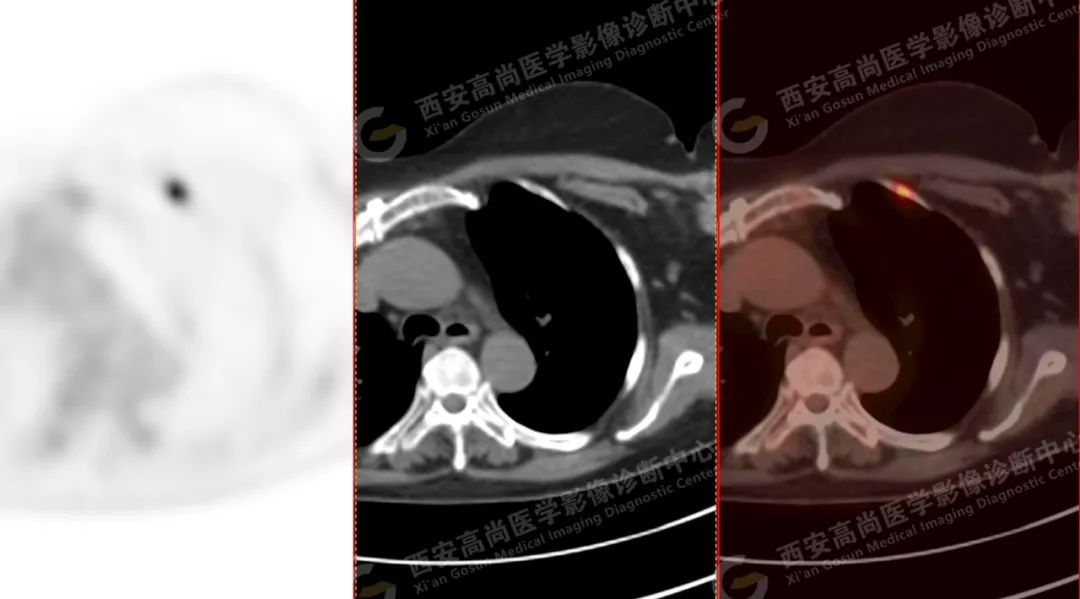 高尚病例：PET/CT 诊断多发性骨髓瘤 1 例