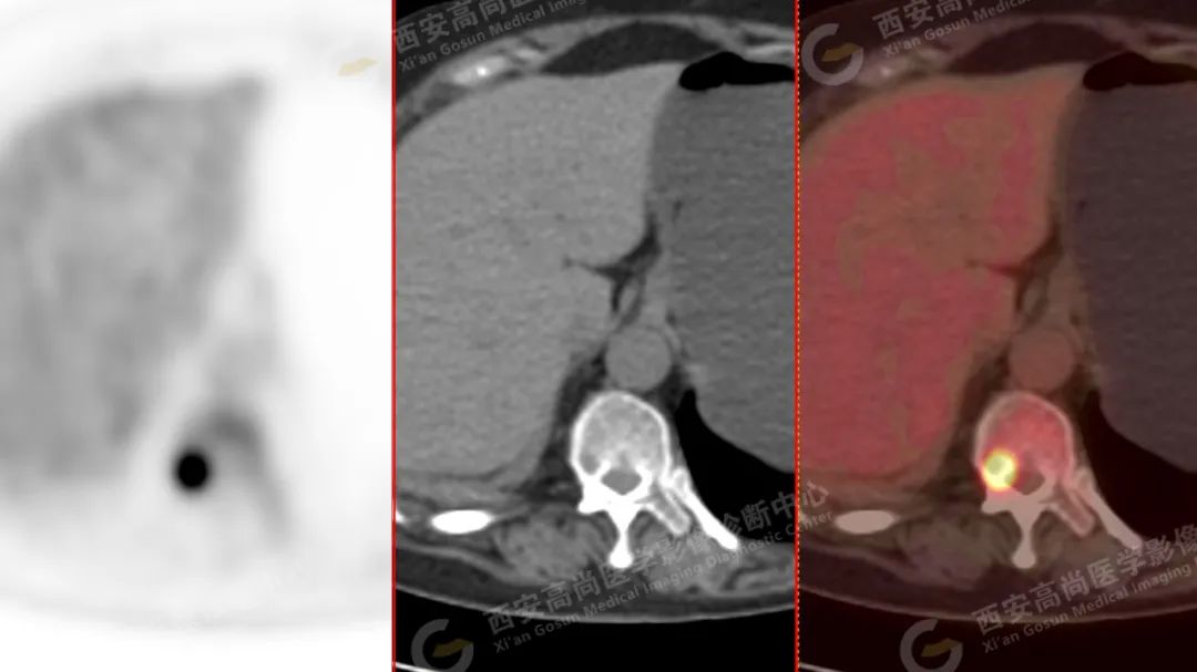 高尚病例：PET/CT 诊断多发性骨髓瘤 1 例