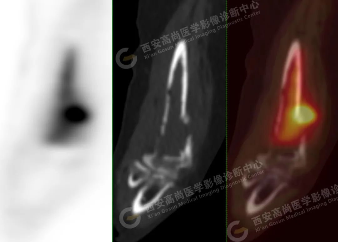 高尚病例：PET/CT 诊断多发性骨髓瘤 1 例