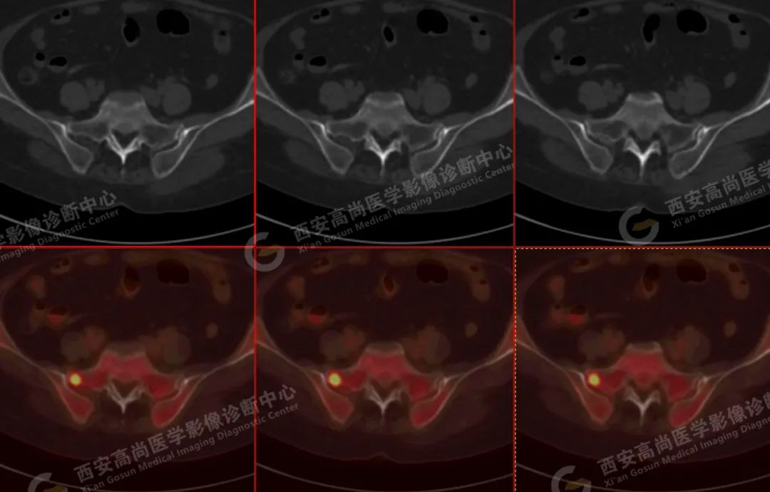 高尚病例：PET/CT 诊断多发性骨髓瘤 1 例