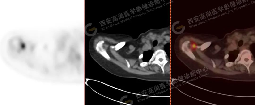 高尚病例：PET/CT 诊断多发性骨髓瘤 1 例