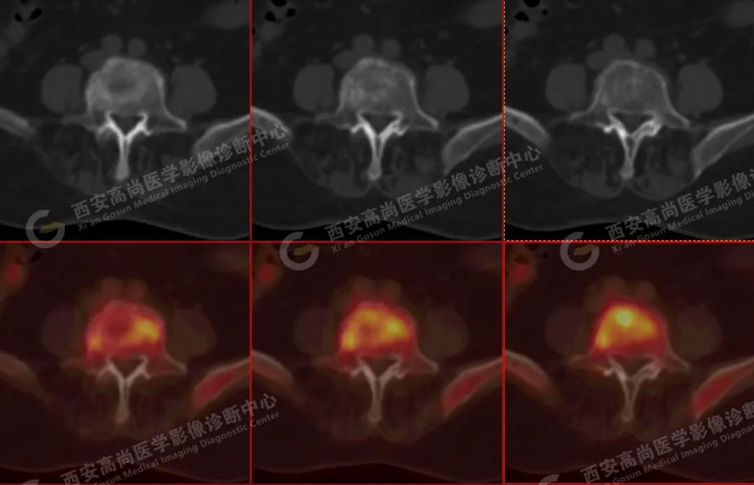 高尚病例：PET/CT 诊断多发性骨髓瘤 1 例