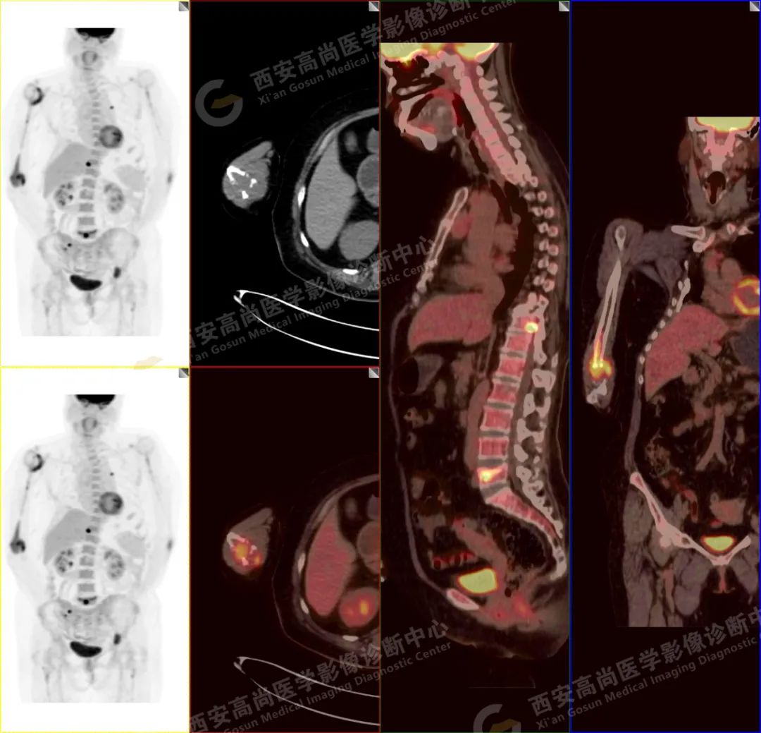 高尚病例：PET/CT 诊断多发性骨髓瘤 1 例