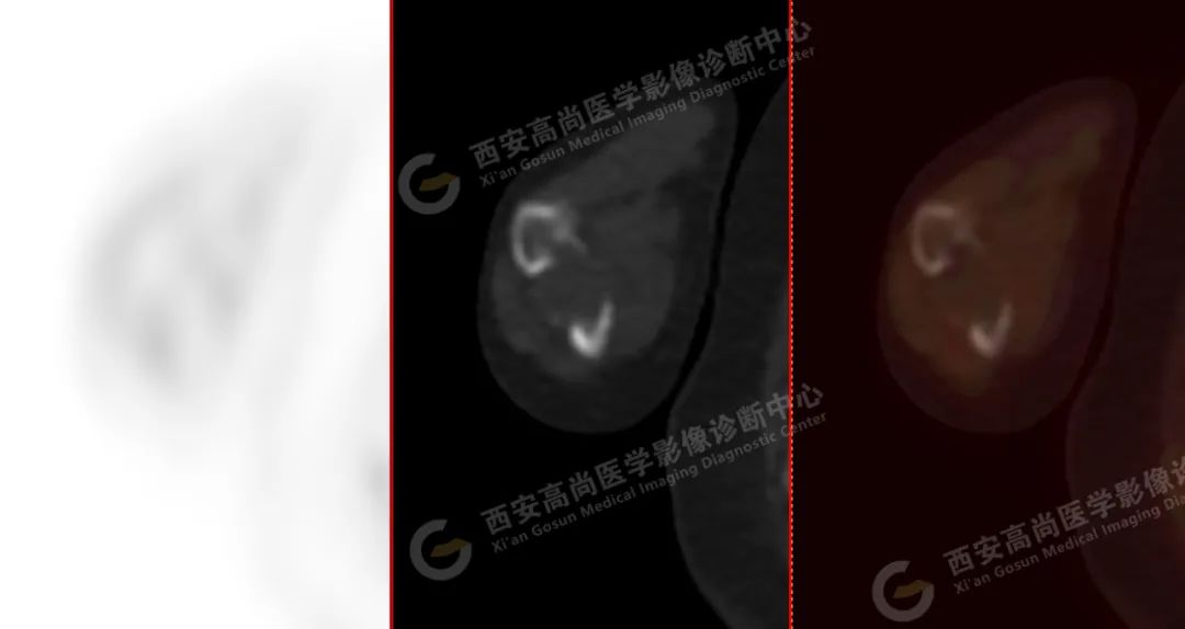 高尚病例：PET/CT 诊断多发性骨髓瘤 1 例