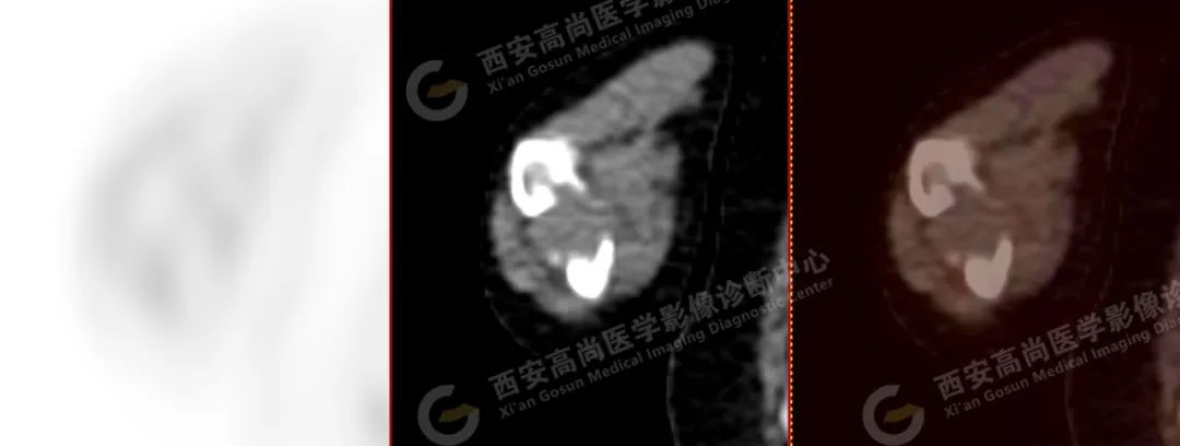 高尚病例：PET/CT 诊断多发性骨髓瘤 1 例
