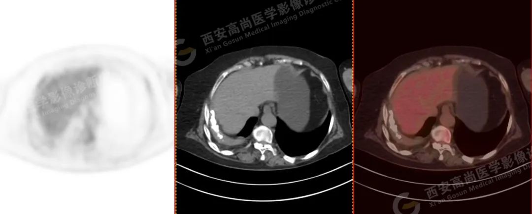 高尚病例：PET/CT 诊断多发性骨髓瘤 1 例