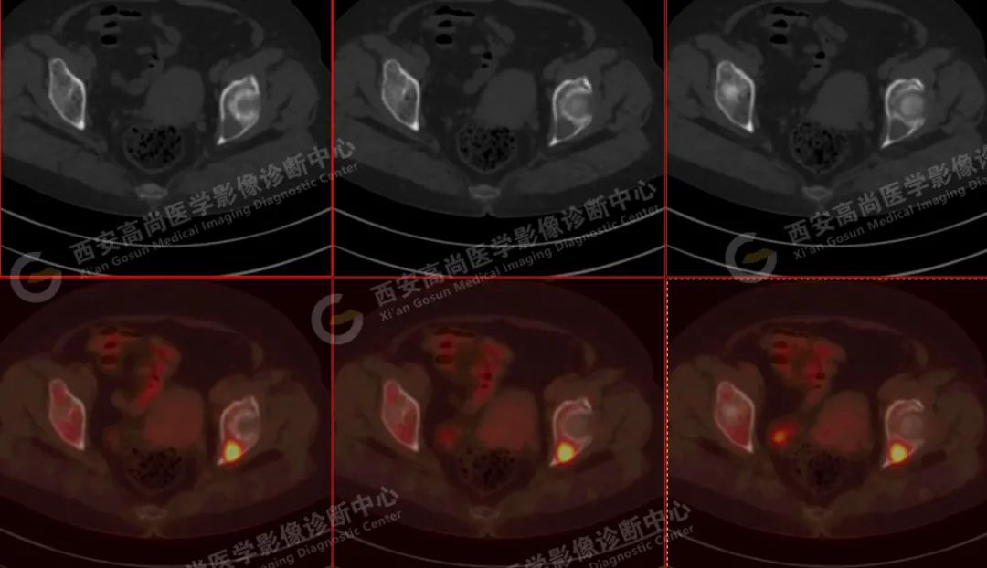 高尚病例：PET/CT 诊断多发性骨髓瘤 1 例