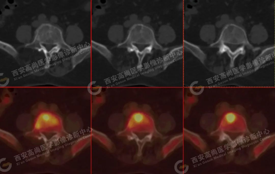 高尚病例：PET/CT 诊断多发性骨髓瘤 1 例
