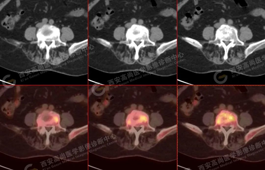 高尚病例：PET/CT 诊断多发性骨髓瘤 1 例