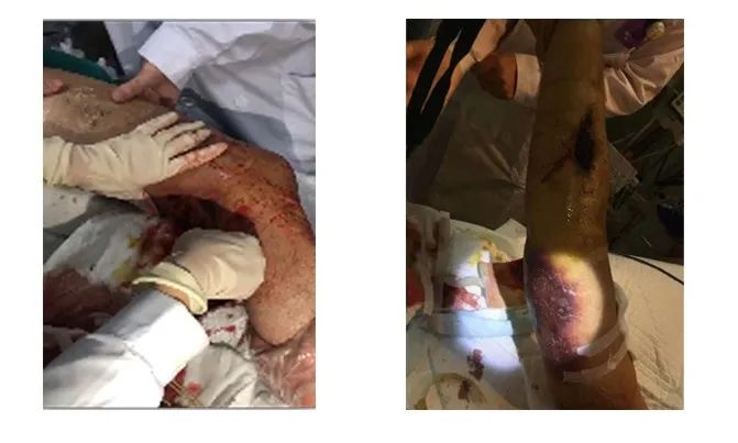 40 余次会诊、18 次大抢救!多学科联合救治,抢回 00 后边防战士生命