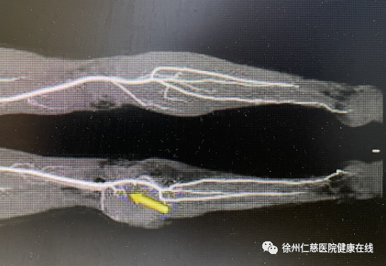 小腿肿瘤屡次复发，侵袭性纤维瘤你了解多少