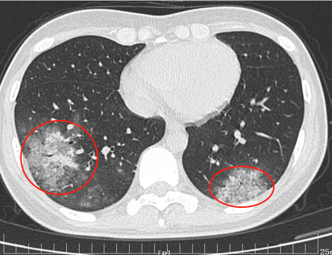 都是鹦鹉「惹的祸」！26 岁养鹦鹉女子因高烧不退住进了医院……