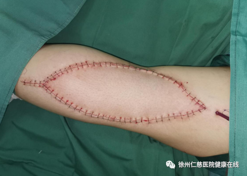 小腿肿瘤屡次复发，侵袭性纤维瘤你了解多少