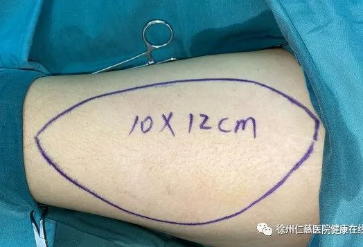 小腿肿瘤屡次复发，侵袭性纤维瘤你了解多少