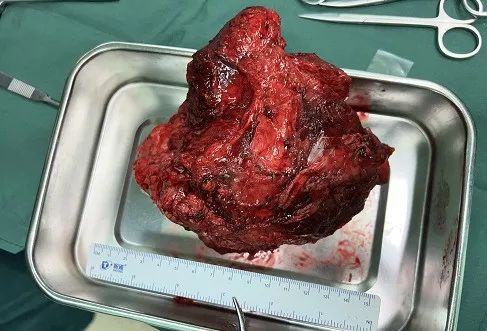 小腿肿瘤屡次复发，侵袭性纤维瘤你了解多少