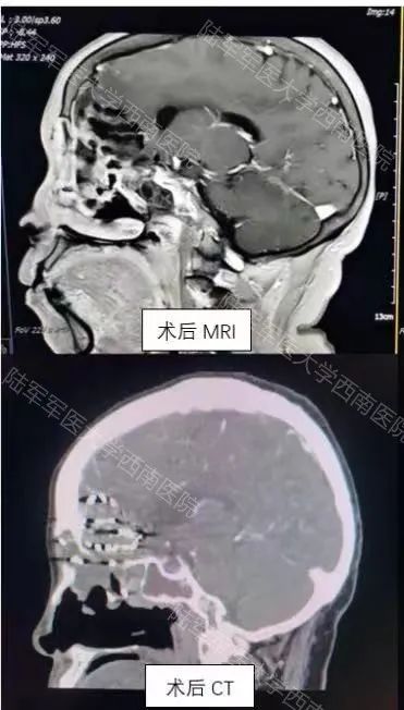 全球首例！核医学科完成碘-125 粒子治疗颅内外交通性、难治性巨大腺样囊腺癌
