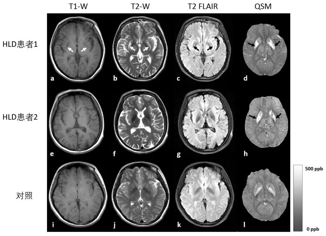 上海市同仁医院王晓平主任医师团队通过 3T MRI 定量磁化率成像手段对肝豆状核变性患者脑内金属沉积情况进行评估