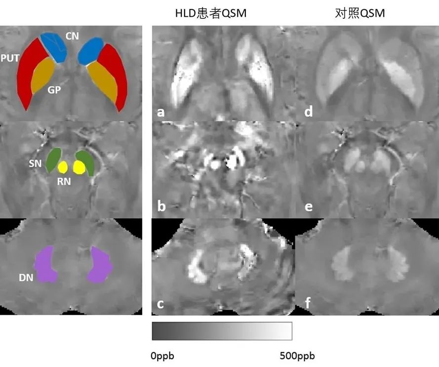 上海市同仁医院王晓平主任医师团队通过 3T MRI 定量磁化率成像手段对肝豆状核变性患者脑内金属沉积情况进行评估