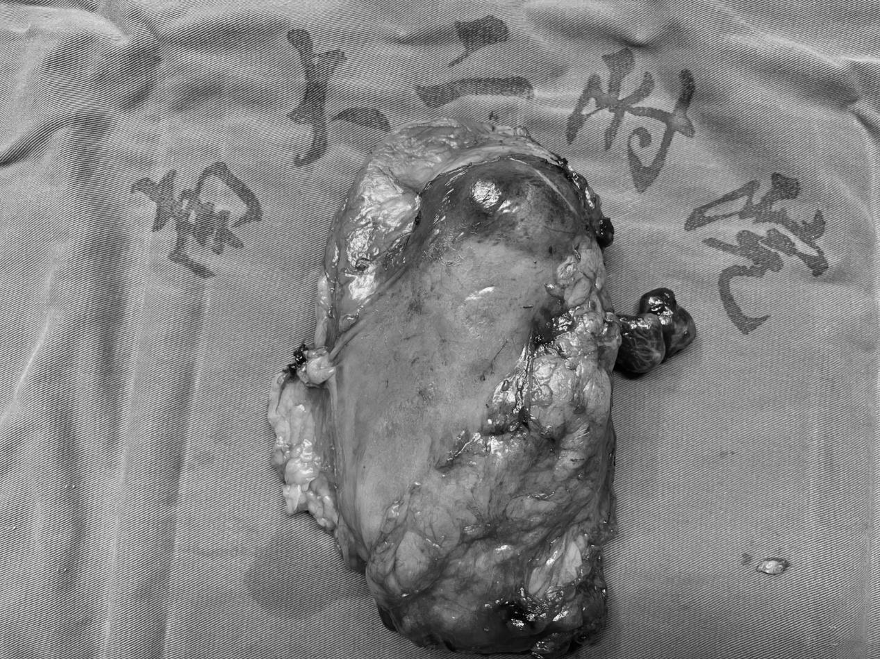 南昌大学二附院泌尿外科成功完成一例肾癌根治+下腔静脉 II 级癌栓取出术