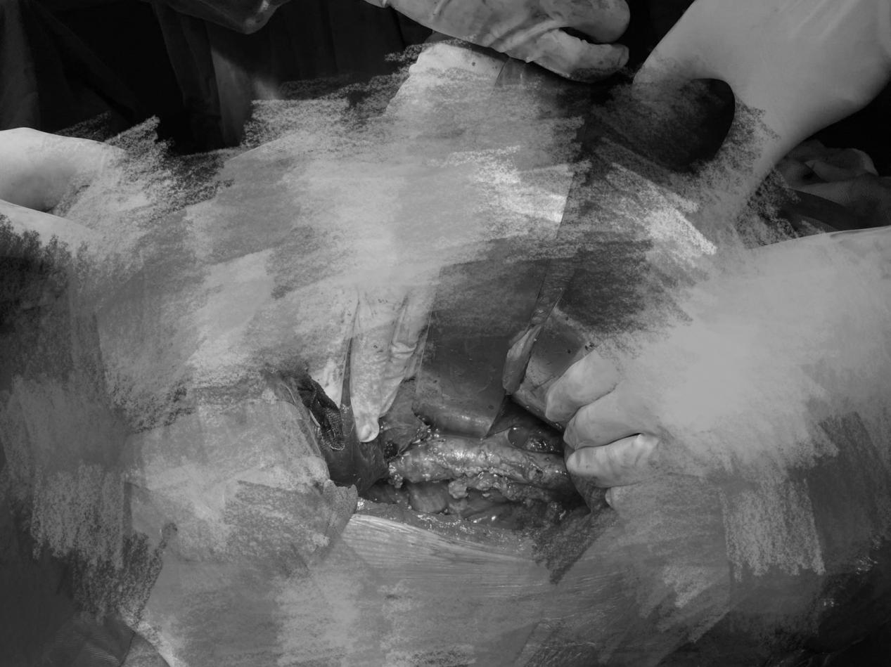 南昌大学二附院泌尿外科成功完成一例肾癌根治+下腔静脉 II 级癌栓取出术