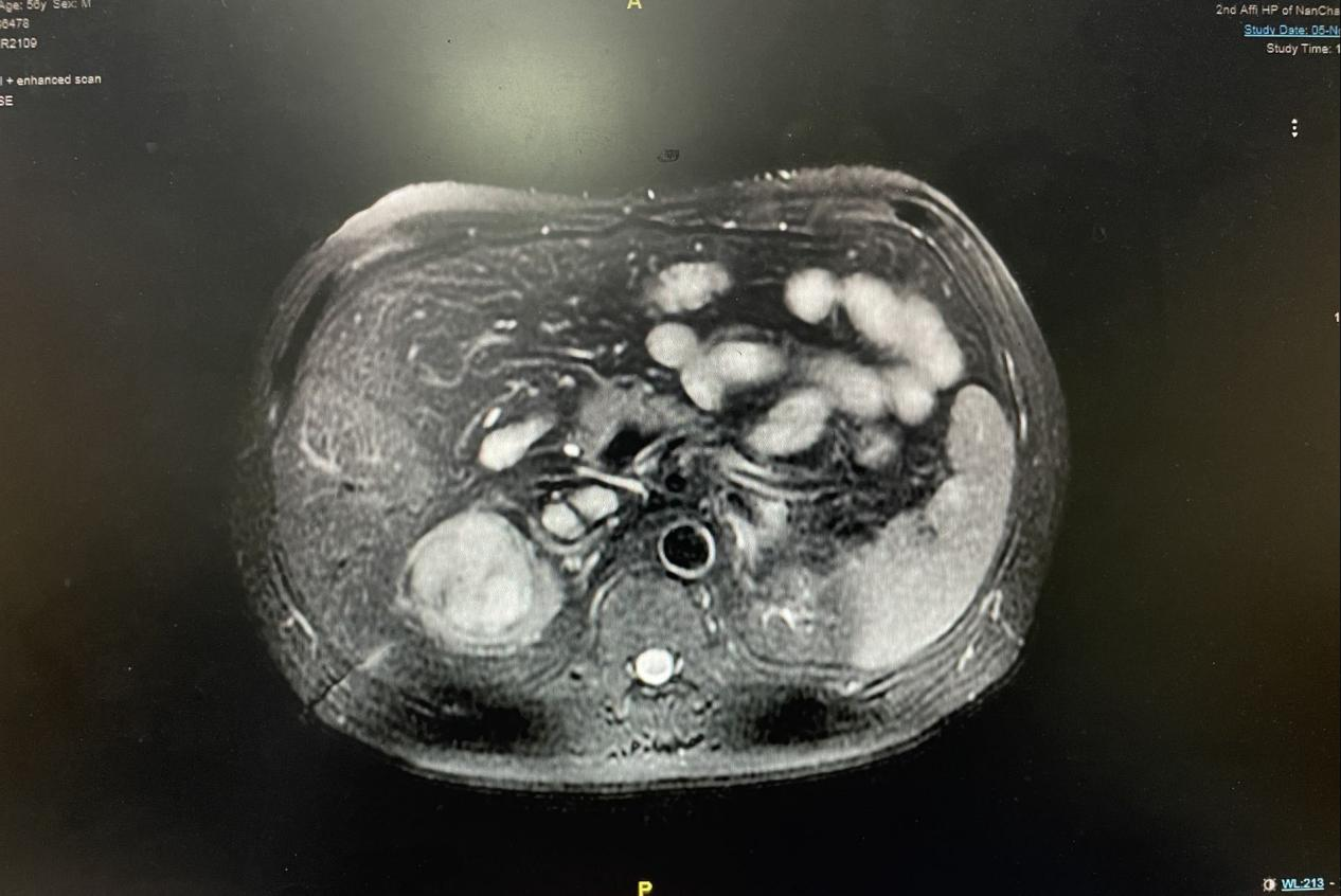 南昌大学二附院泌尿外科成功完成一例肾癌根治+下腔静脉 II 级癌栓取出术